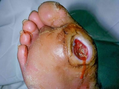Diabetic Foot Ulcer: Symptoms, Causes, Treatment & Prevention | SND Multispeciality Hospital