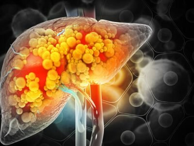 Fatty Liver Treatment in Jaipur | SND Multispeciality Hospital Fatty Liver Disease: Symptoms, Causes, Treatment & Prevention