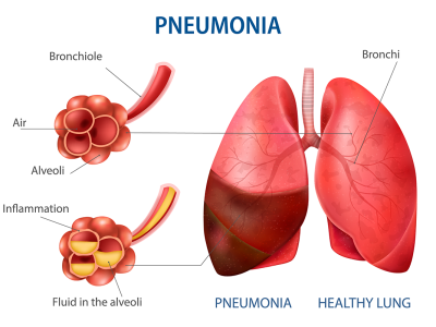 Pneumonia Treatment in Jaipur | SND Multispeciality Hospital Pneumonia: Symptoms, Causes, Treatment & Prevention