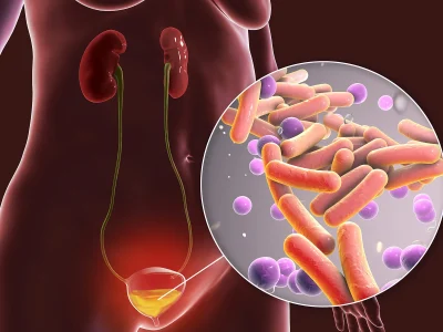 Urinary Tract Infection (UTI): Symptoms, Causes, Treatment & Prevention