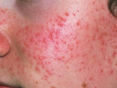 Acne Treatment in Jaipur | SND Multispeciality Hospital