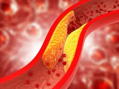 High Cholesterol Treatment in Jaipur | SND Multispeciality Hospital