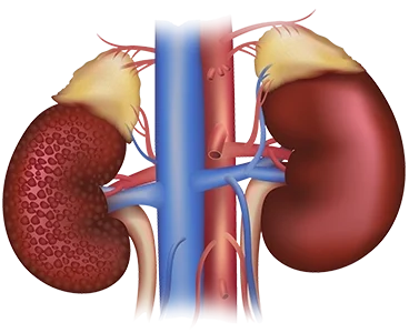 Diabetic Nephropathy Treatment in Jaipur | SND Multispeciality Hospital