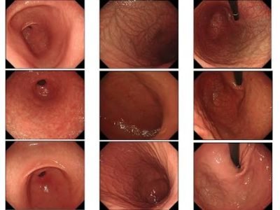 Gastric & Acidity Treatment in Jaipur | SND Multispeciality Hospital