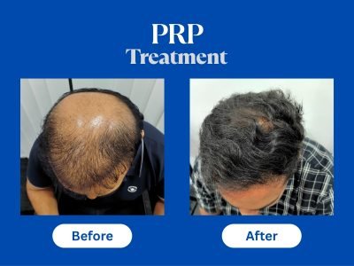 Hair Treatment in Jaipur | SND Multispeciality Hospital
