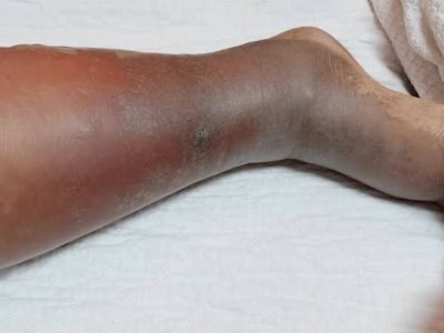 Cellulitis Treatment in Jaipur | SND Multispeciality Hospital
