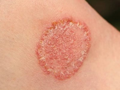 Fungal Infection Treatment in Jaipur | SND Multispeciality Hospital